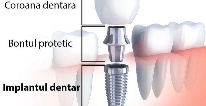 implantul dentar dentocare